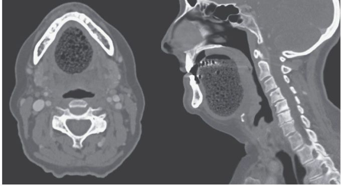 A Sublingual Epidermoid Cyst