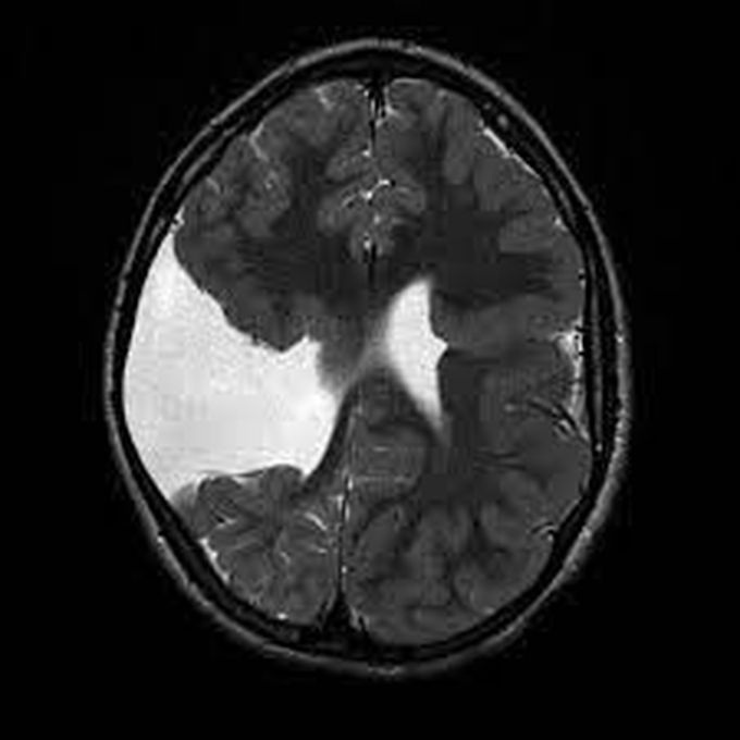 Schizencephaly MEDizzy