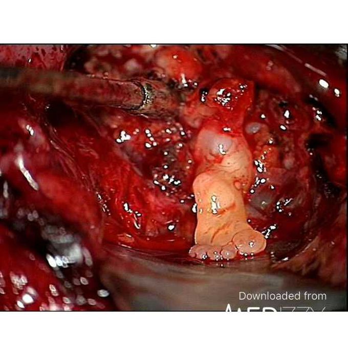 Baby born with a foot in his brain
