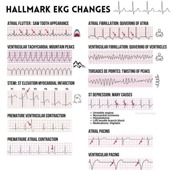 EKG CHANGES