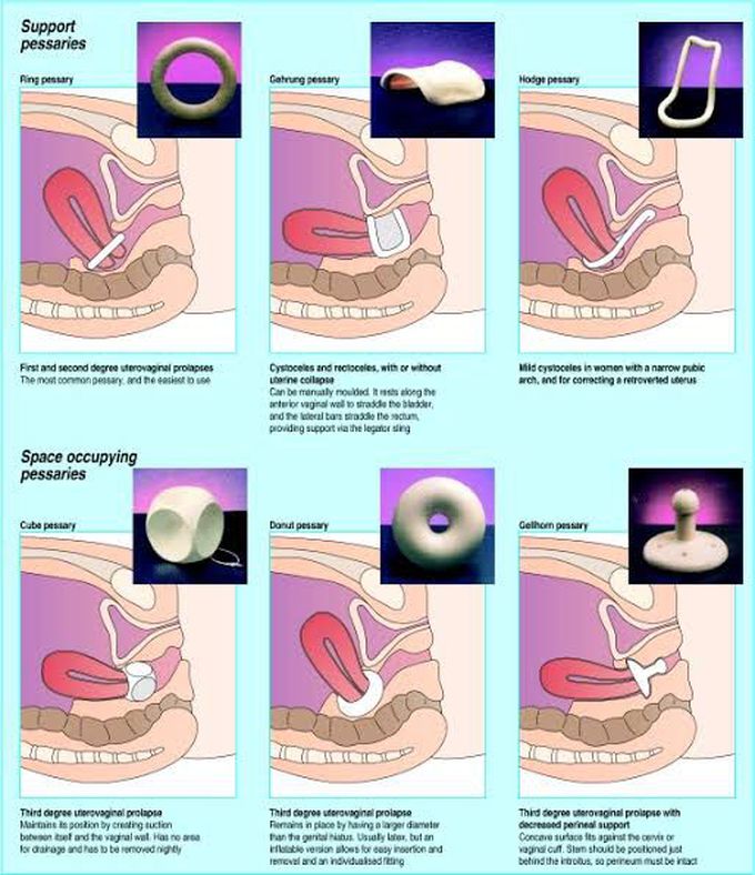 Management of Genital Prolapse