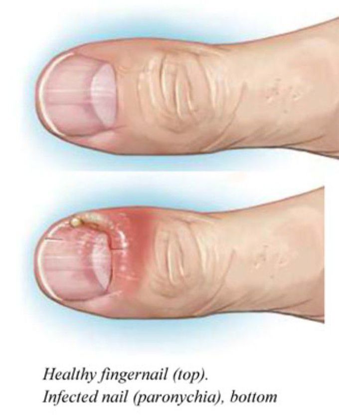 Bacterial nail infection treatment