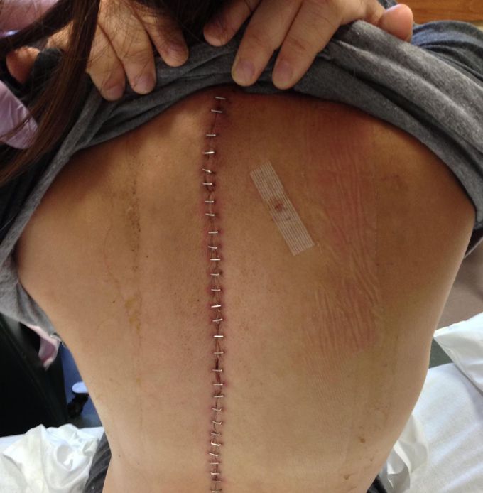 Scoliosis #2