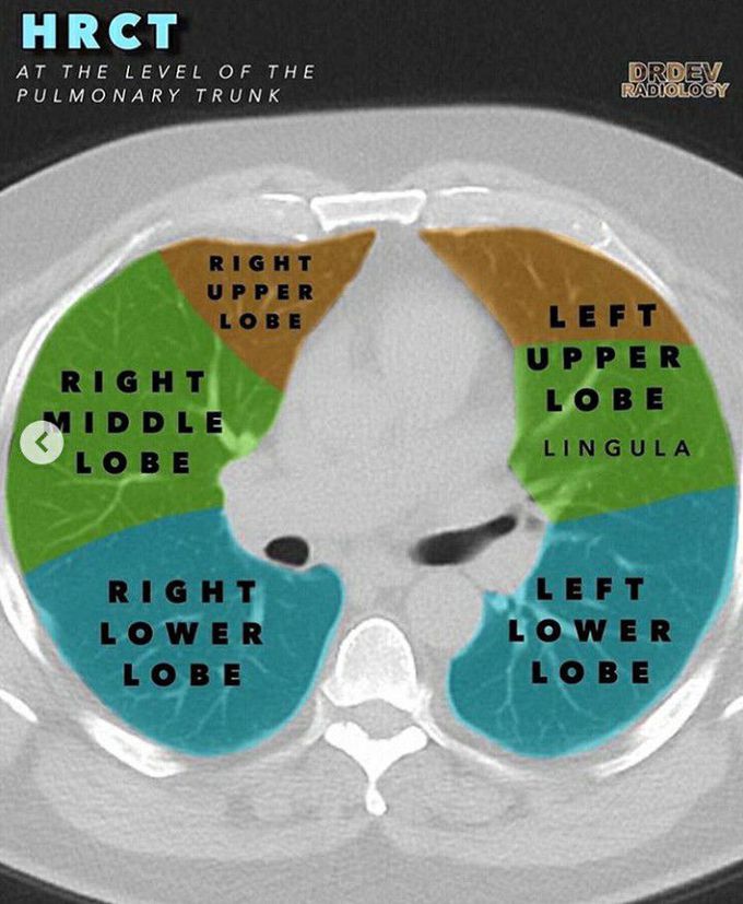 Chest HRCT scan