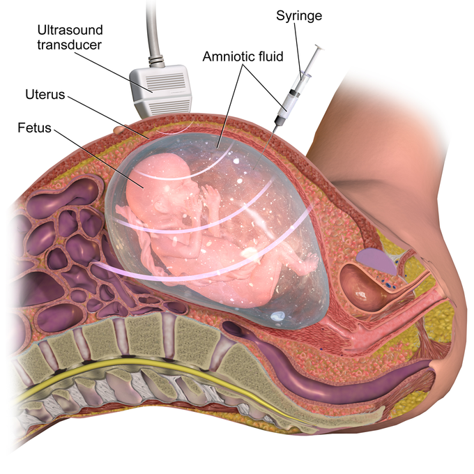 What does amniocentesis test for?