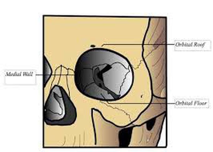 What Is A Blowout Fracture