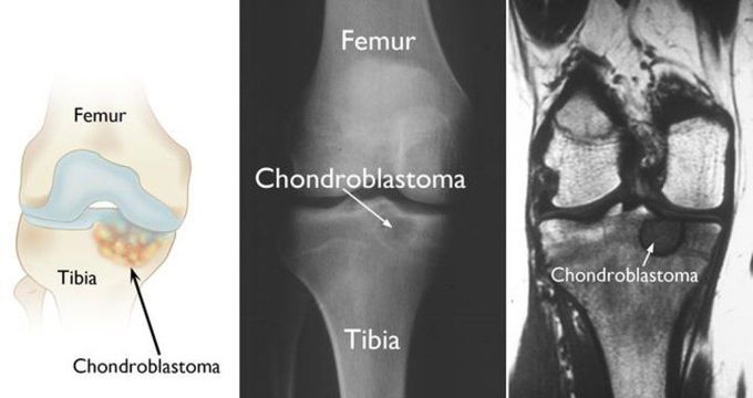 Treatment of chondroblastoma