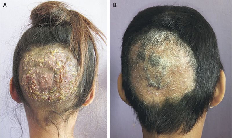 Varieties of Tinea Capitis - MEDizzy