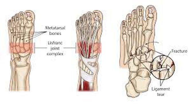 What causes a lisfranc injury