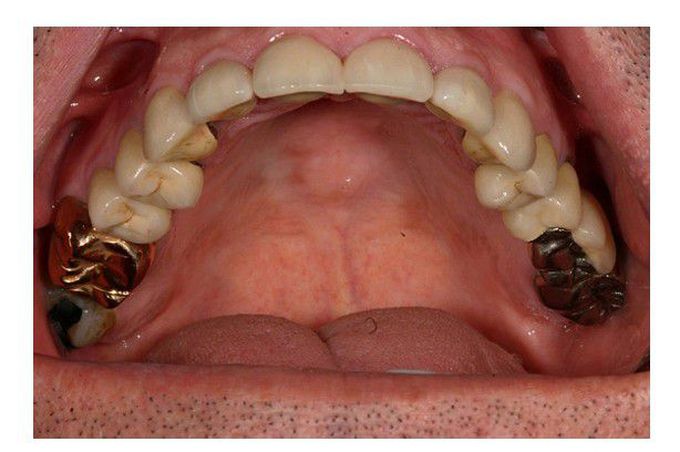 Fixed dental prosthesis