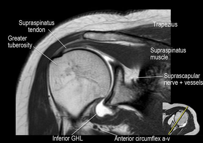 SHOULDER MRI
