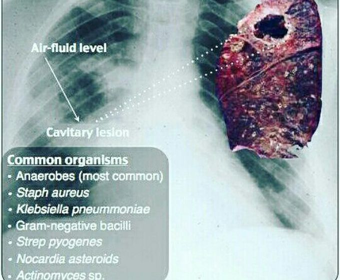 Lung abscess