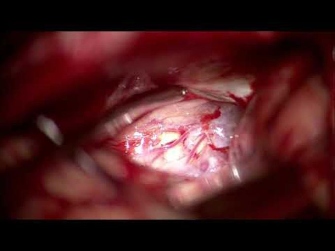 Microsurgical laser resection of brainstem cavernous malformations