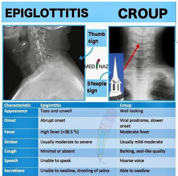 Epiglottitis Vs Croup