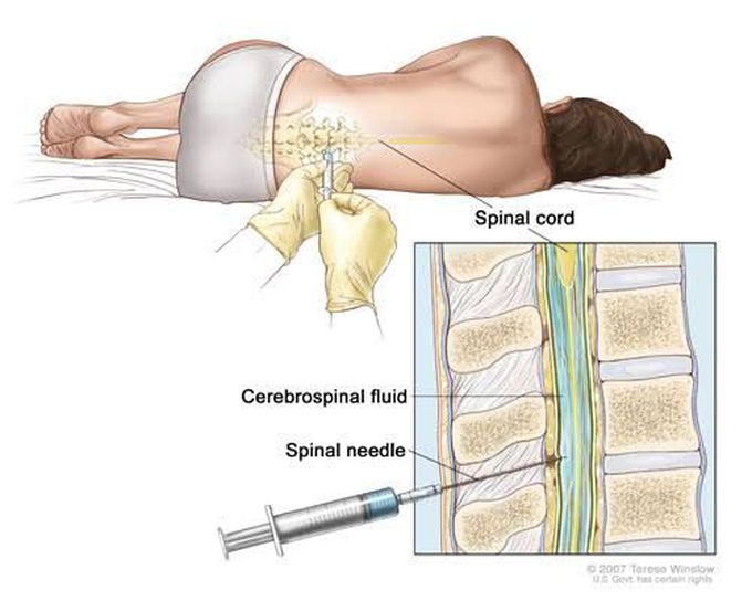 Meningococcemia treatment