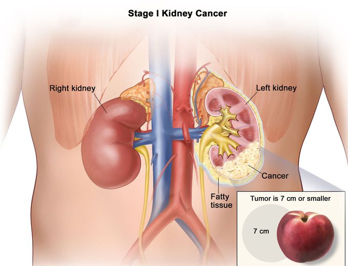 Kidney Cancer