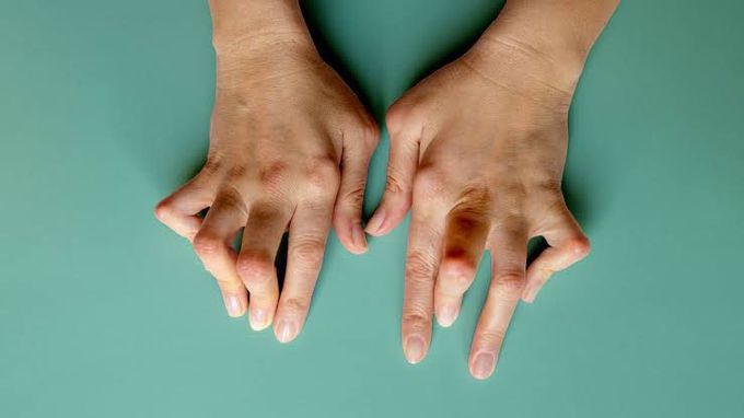What is Rheumatoid arthritis?