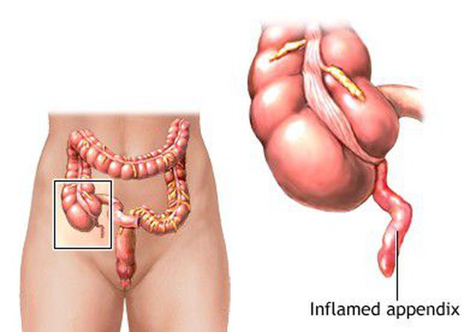 Appendicitis