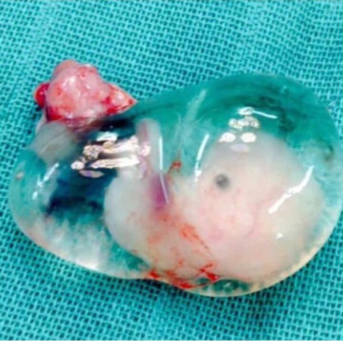 A case of ectopic pregnancy