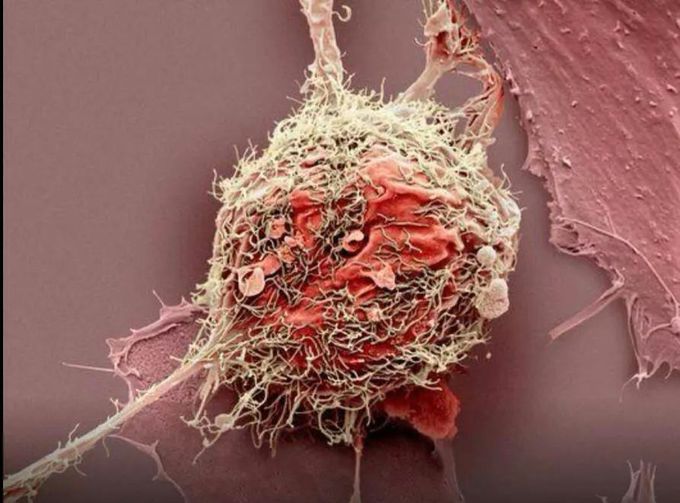 Bone Cancer Cell in Microscopic images
