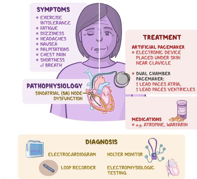 Treatment for Sinus Tachycardia