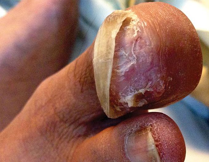 Brown tumour