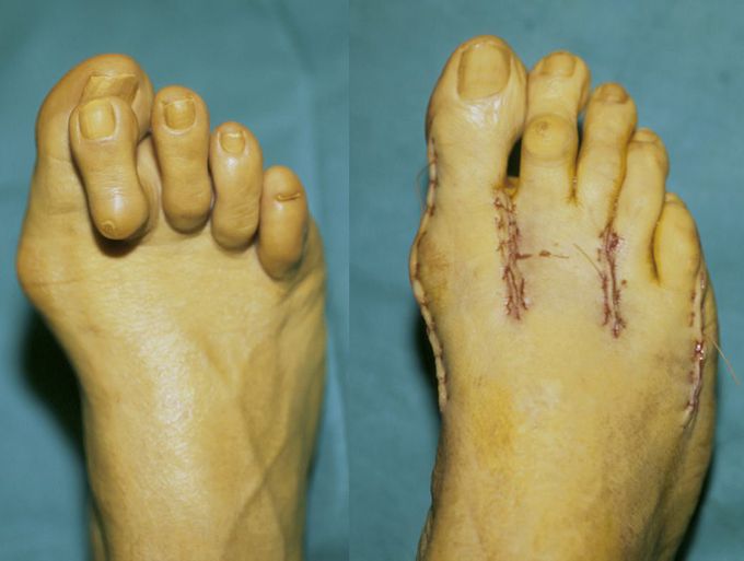 Hammer toes before and after surgery - MEDizzy