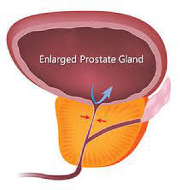 What is Benign prostatic hyperplasia