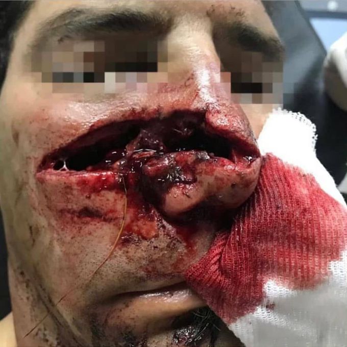 Facial trauma caused by the tusk of a wild boar! 