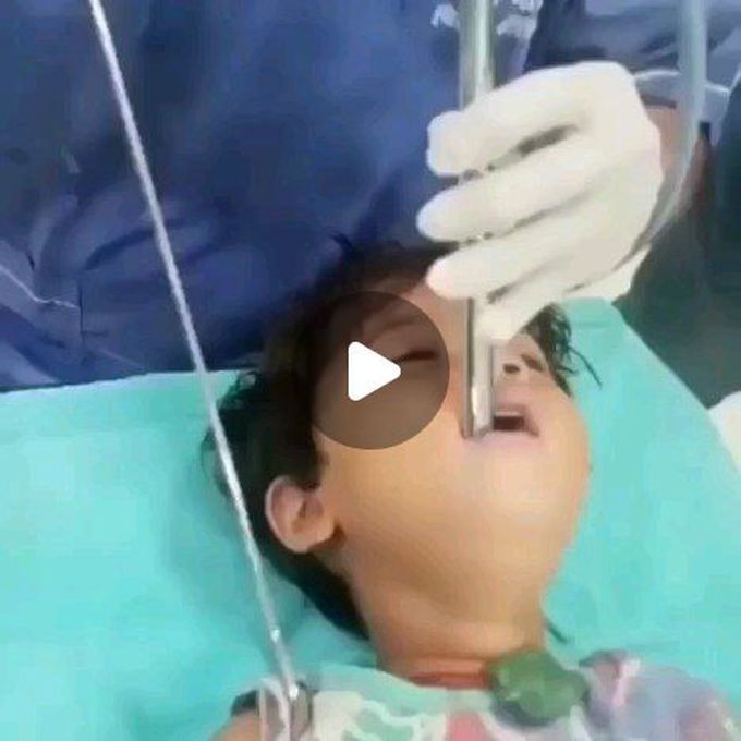 Gastric coin extraction in child