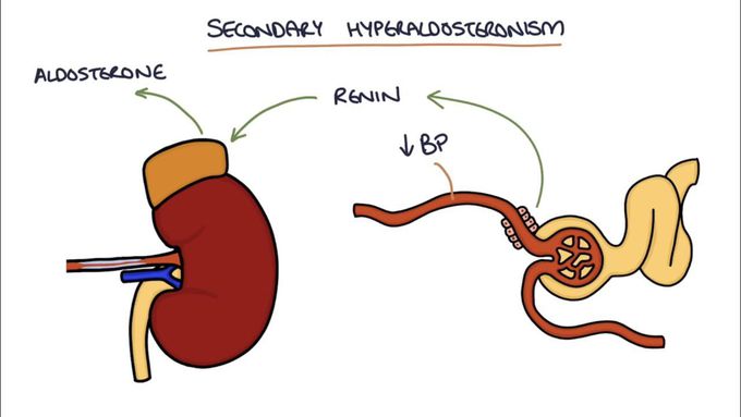 Hyperaldosteronism and Conn's Syndrome: Visual Explanation for Students