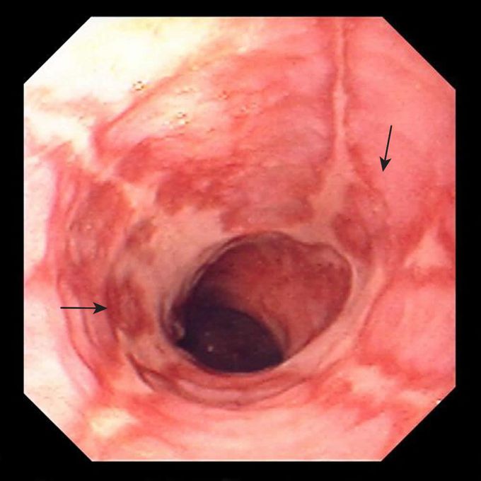 Complications of Gastroesophageal Reflux Disease