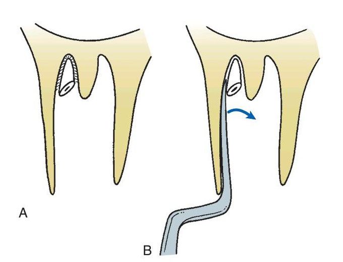 Retrieval of fractured root