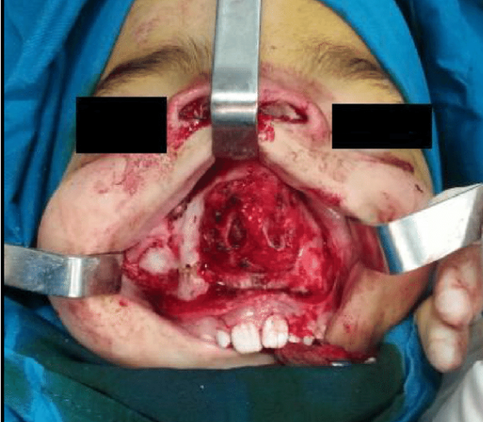 Nightmare of an ent surgeon💀💀💀