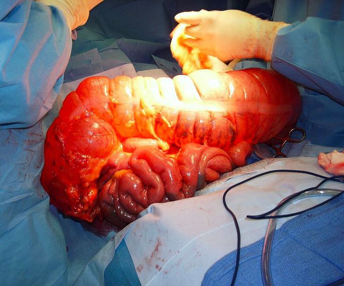 Megacolon