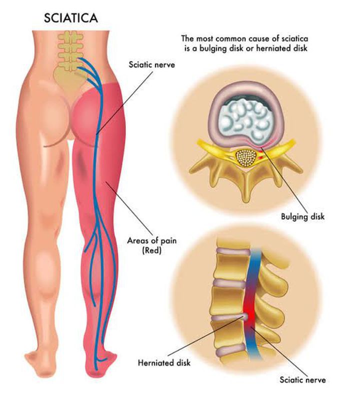 Treatment of sciatica