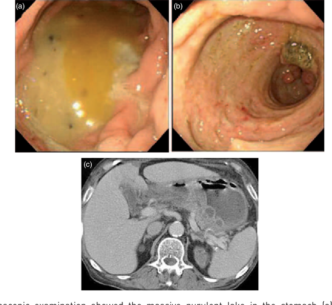 Phlegmonous Gastritis