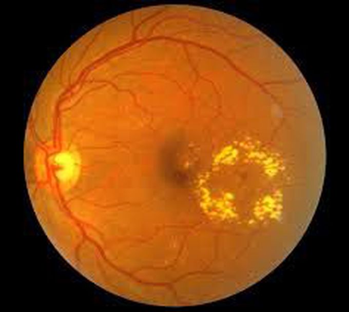 Symptoms of cystoid macular edema