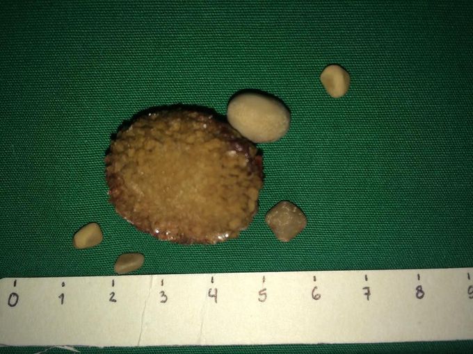 Bladder stone