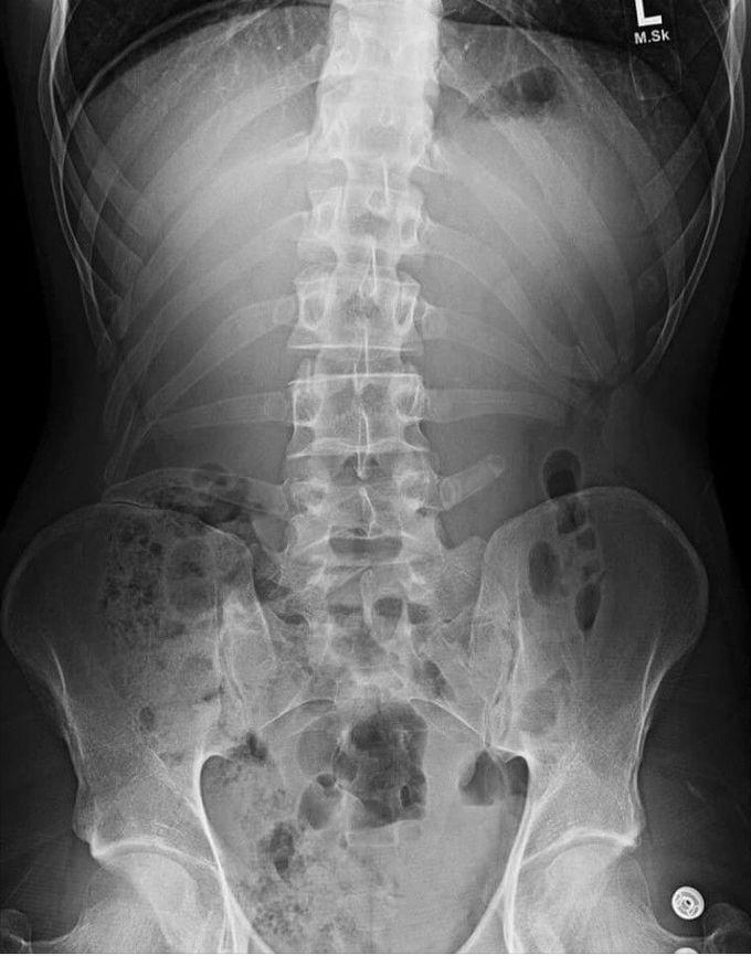 What unusual syndrome does this patient suffer from? Can you spot the related medical emergency?....