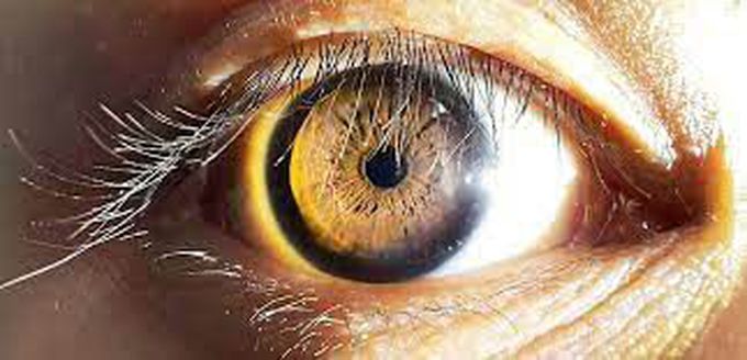 Treatment of Miosis