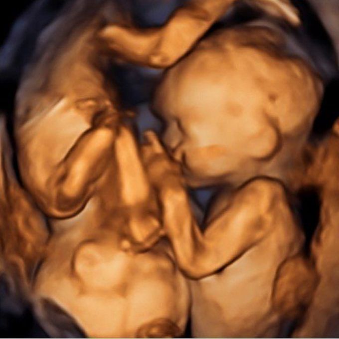 This 3D ultrasound of baby twins will melt your heart - MEDizzy