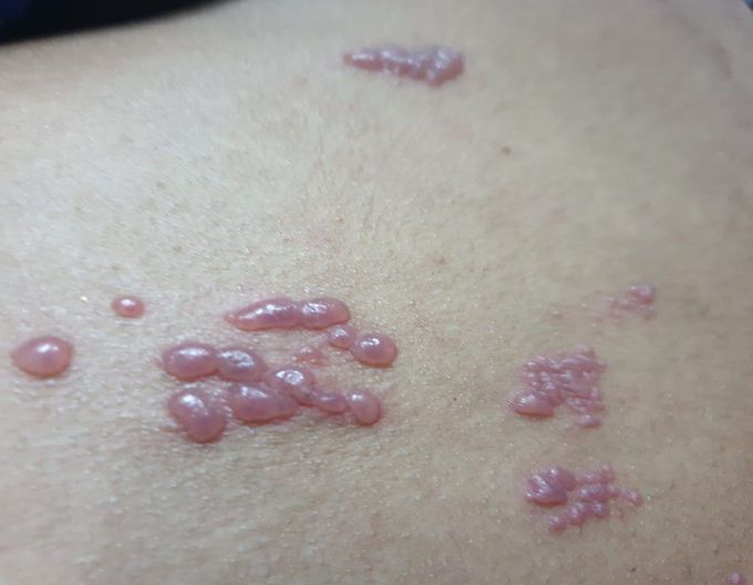 Identify the disease?