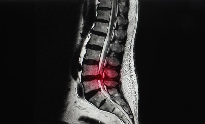 Spinal stenosis