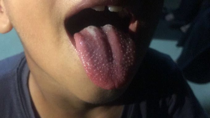 Diagnosis ?