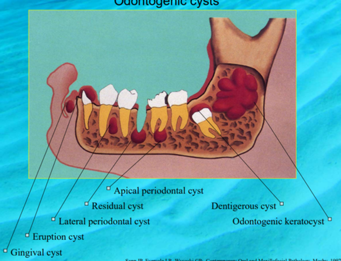 Odontogenic cysts