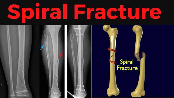 Spiral fracture