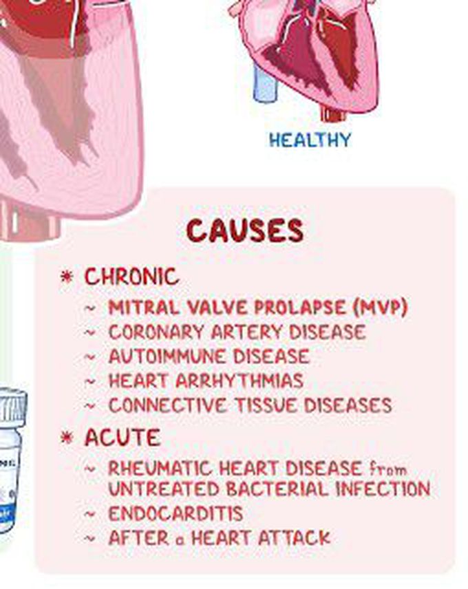 These are the causes of Mitral valve prolapse