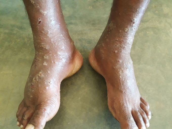 Skin rash expose to cement