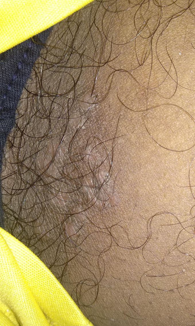 What skin disease this is??What can be the treatment?